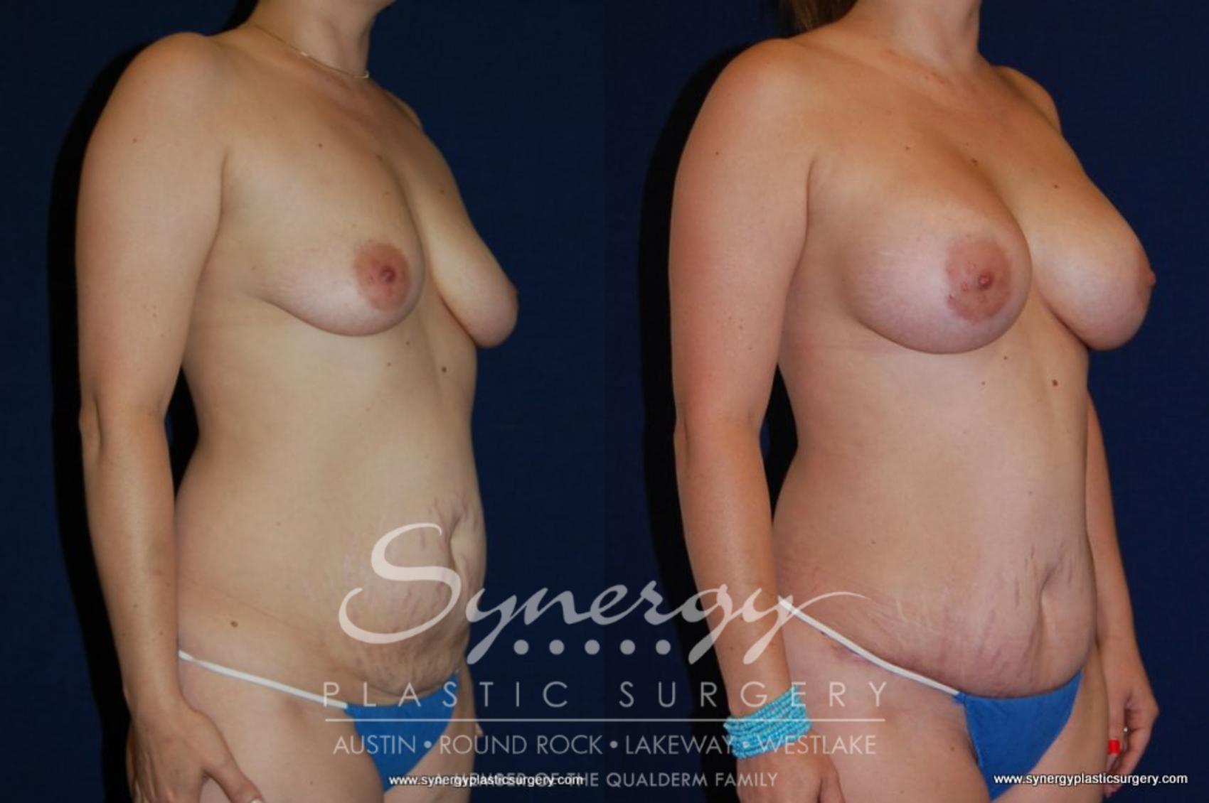 Before & After Mommy Makeover Case 150 View #4 View in Austin, TX