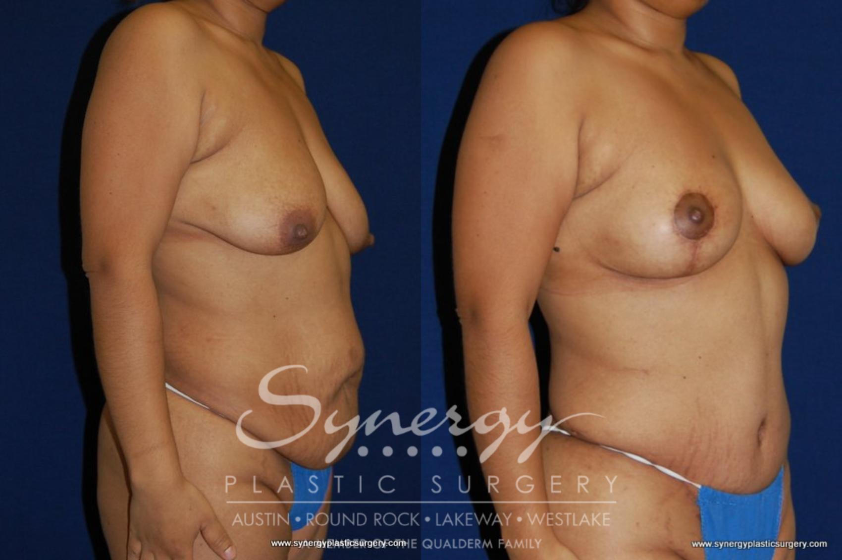 Before & After Mommy Makeover Case 154 View #1 View in Austin, TX