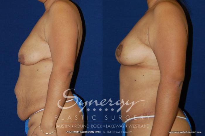 Before & After Mommy Makeover Case 154 View #2 View in Austin, TX