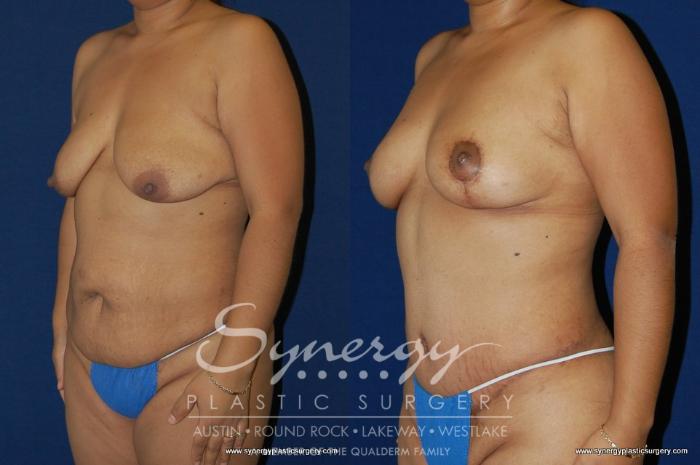 Before & After Mommy Makeover Case 154 View #4 View in Austin, TX
