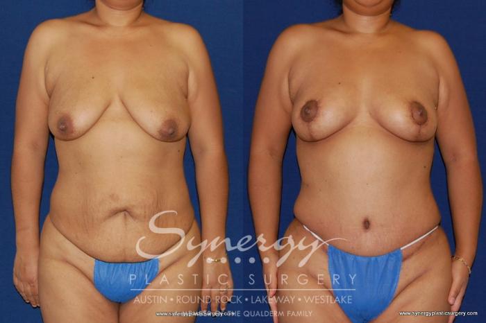 Before & After Mommy Makeover Case 154 View #5 View in Austin, TX