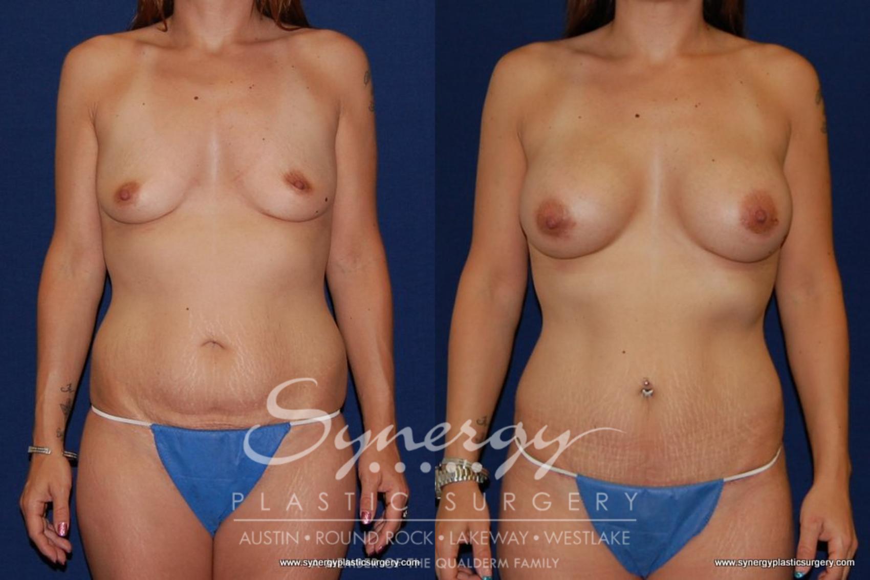 Before & After Mommy Makeover Case 178 View #1 View in Austin, TX