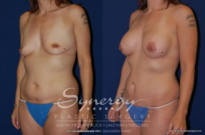 Before & After Mommy Makeover Case 178 View #2 View in Austin, TX