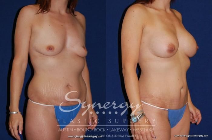 Before & After Mommy Makeover Case 178 View #3 View in Austin, TX