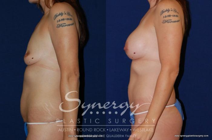 Before & After Mommy Makeover Case 178 View #4 View in Austin, TX