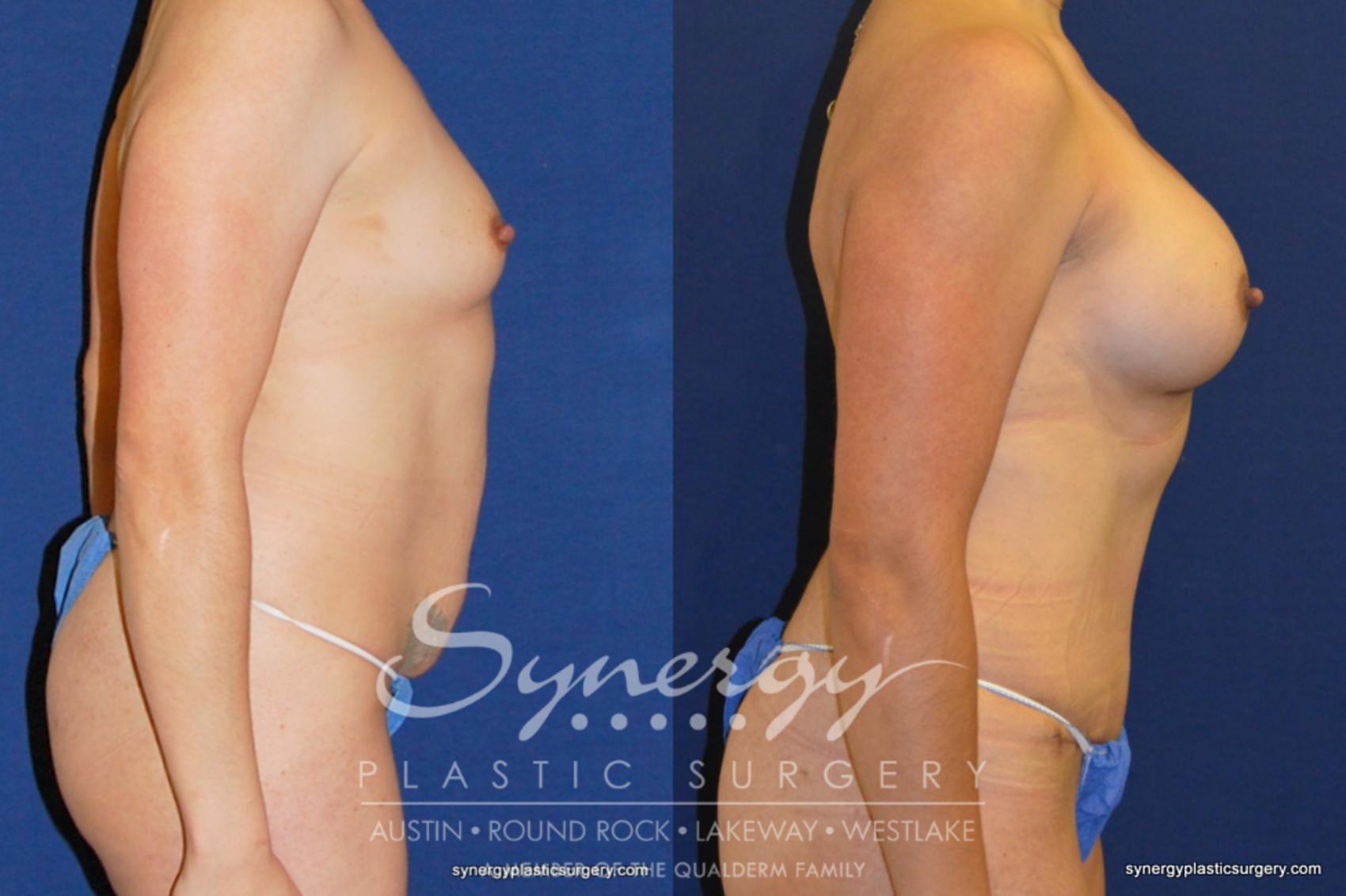 Before & After Mommy Makeover Case 203 View #1 View in Austin, TX