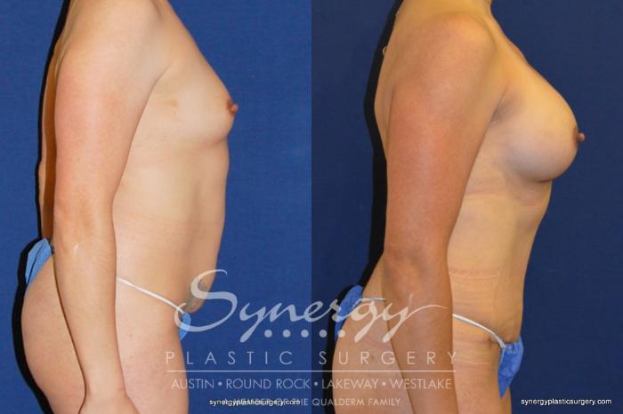 Before & After Mommy Makeover Case 203 View #1 View in Austin, TX