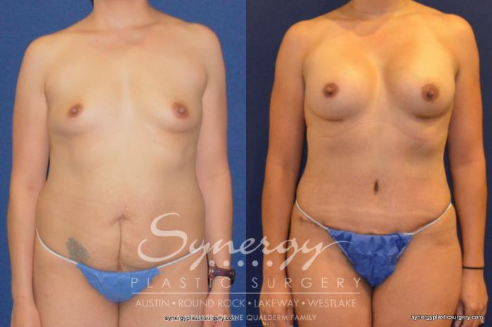 Before & After Mommy Makeover Case 203 View #2 View in Austin, TX