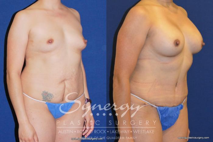 Before & After Mommy Makeover Case 203 View #3 View in Austin, TX