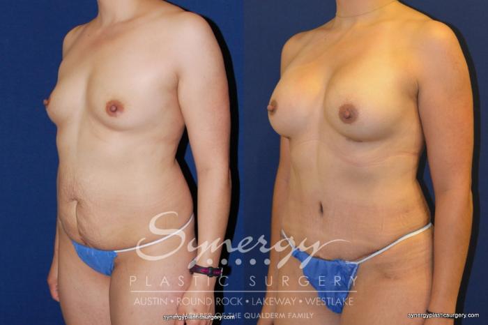 Before & After Mommy Makeover Case 203 View #4 View in Austin, TX