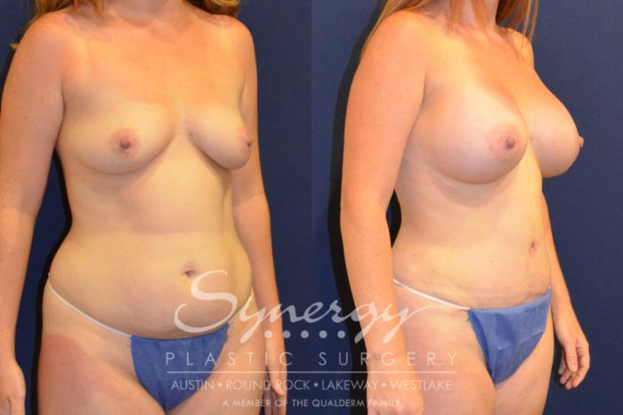 Before & After Mommy Makeover Case 214 View #2 View in Austin, TX