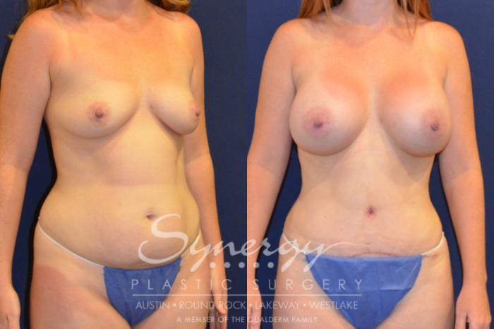 Before & After Mommy Makeover Case 214 View #4 View in Austin, TX