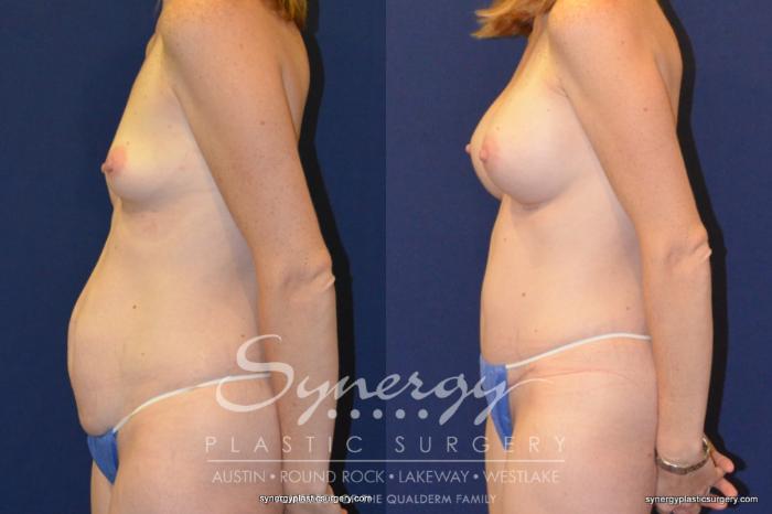 Before & After  Case 251 View #1 View in Austin, TX