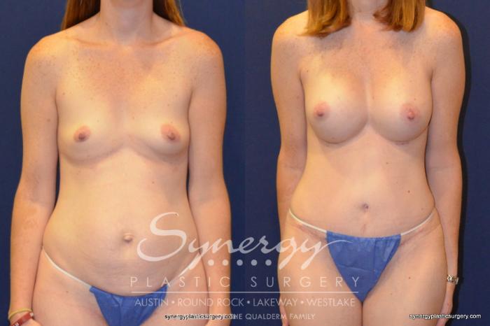 Before & After  Case 251 View #2 View in Austin, TX