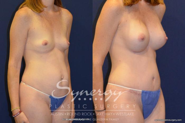 Before & After  Case 251 View #4 View in Austin, TX