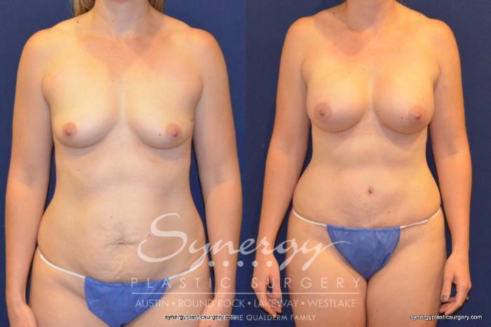 Before & After Mommy Makeover Case 256 View #2 View in Austin, TX