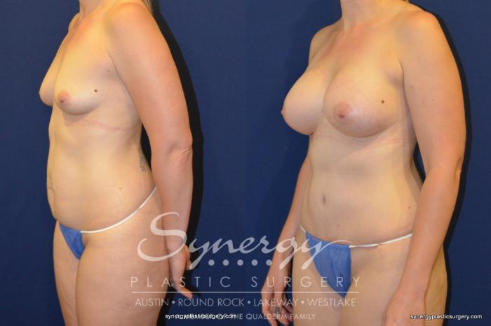 Before & After Mommy Makeover Case 256 View #4 View in Austin, TX