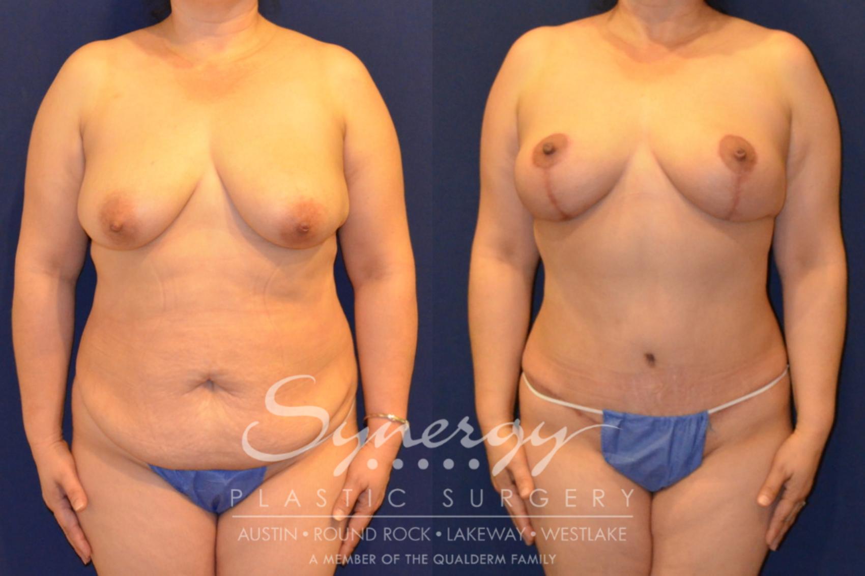 Before & After Mommy Makeover Case 288 View #1 View in Austin, TX