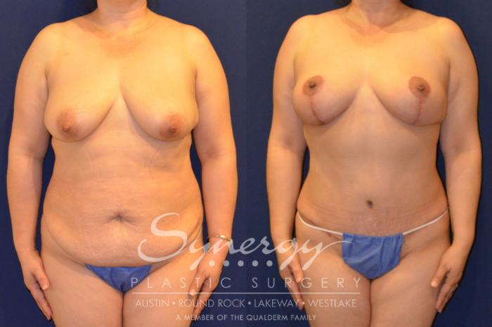 Before & After Mommy Makeover Case 288 View #1 View in Austin, TX