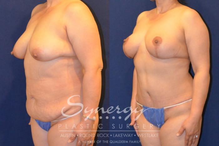 Before & After Mommy Makeover Case 288 View #2 View in Austin, TX