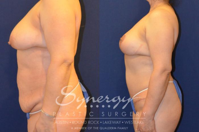 Before & After Mommy Makeover Case 288 View #3 View in Austin, TX