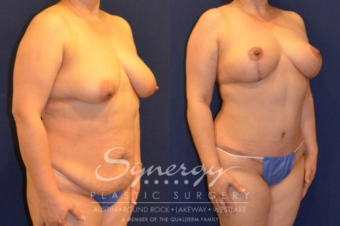 Before & After Mommy Makeover Case 288 View #4 View in Austin, TX