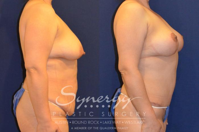 Before & After Mommy Makeover Case 288 View #5 View in Austin, TX