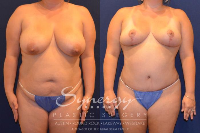 Before & After Mommy Makeover Case 295 View #1 View in Austin, TX