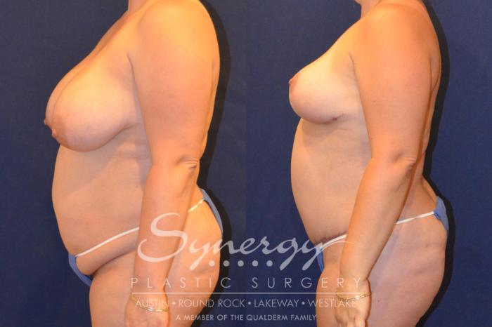 Before & After Mommy Makeover Case 295 View #5 View in Austin, TX