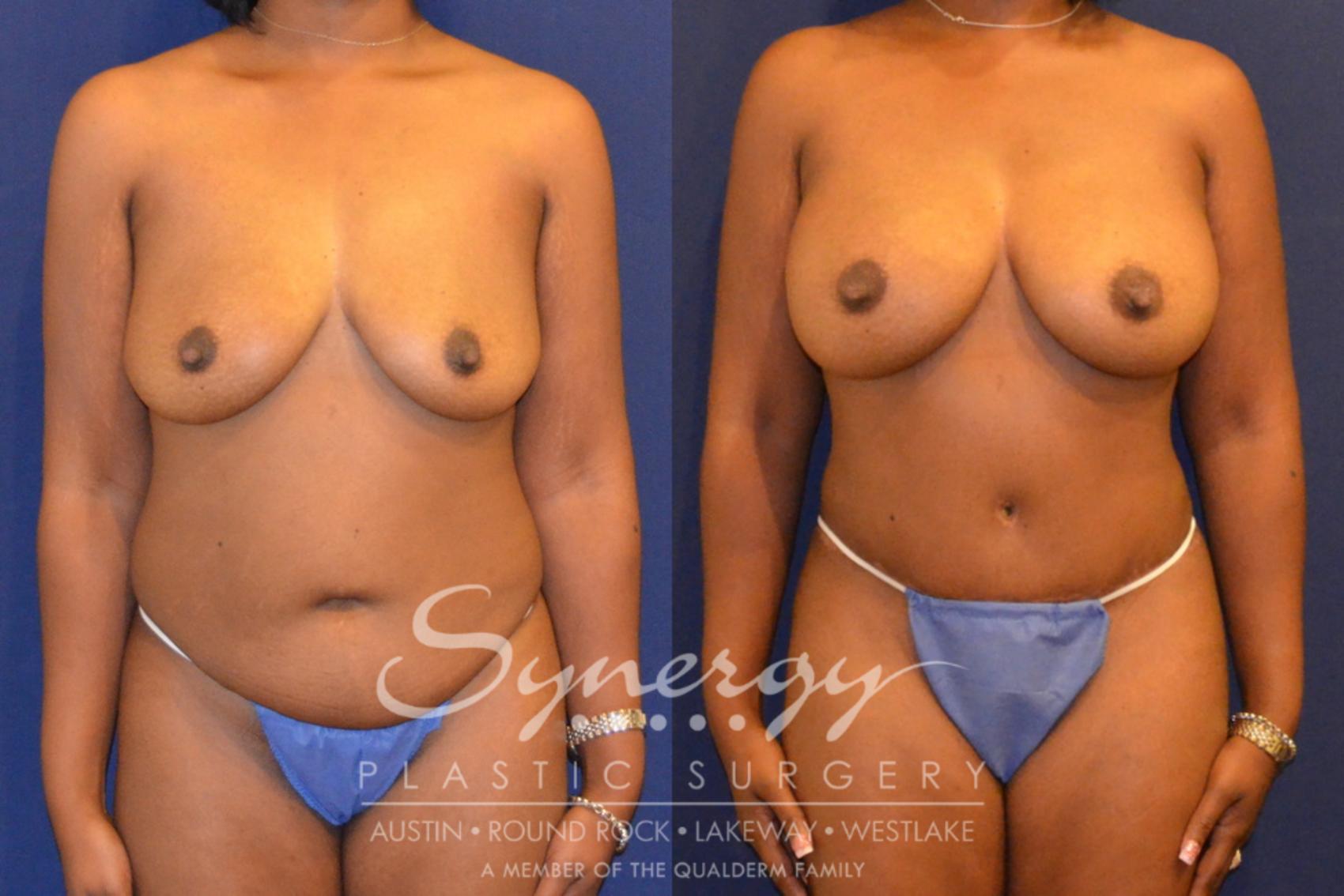 Before & After Mommy Makeover Case 297 View #1 View in Austin, TX