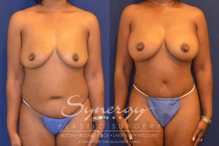 Before & After  Case 297 View #1 View in Austin, TX