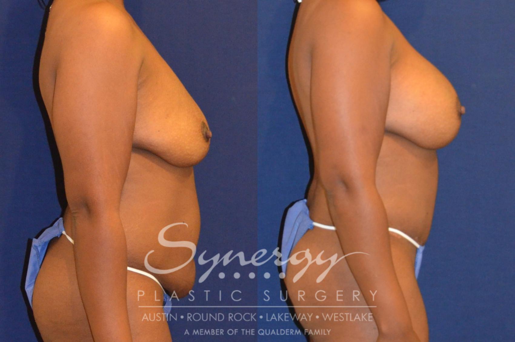 Before & After Mommy Makeover Case 297 View #2 View in Austin, TX