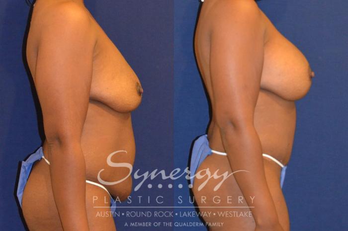 Before & After  Case 297 View #2 View in Austin, TX