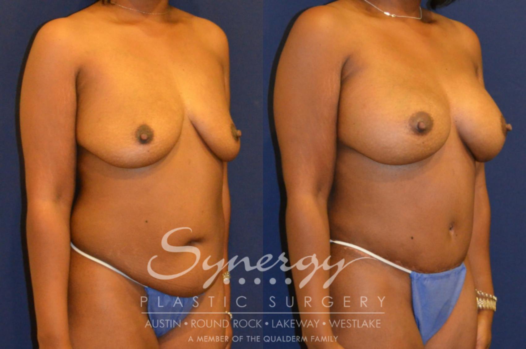 Before & After Mommy Makeover Case 297 View #3 View in Austin, TX