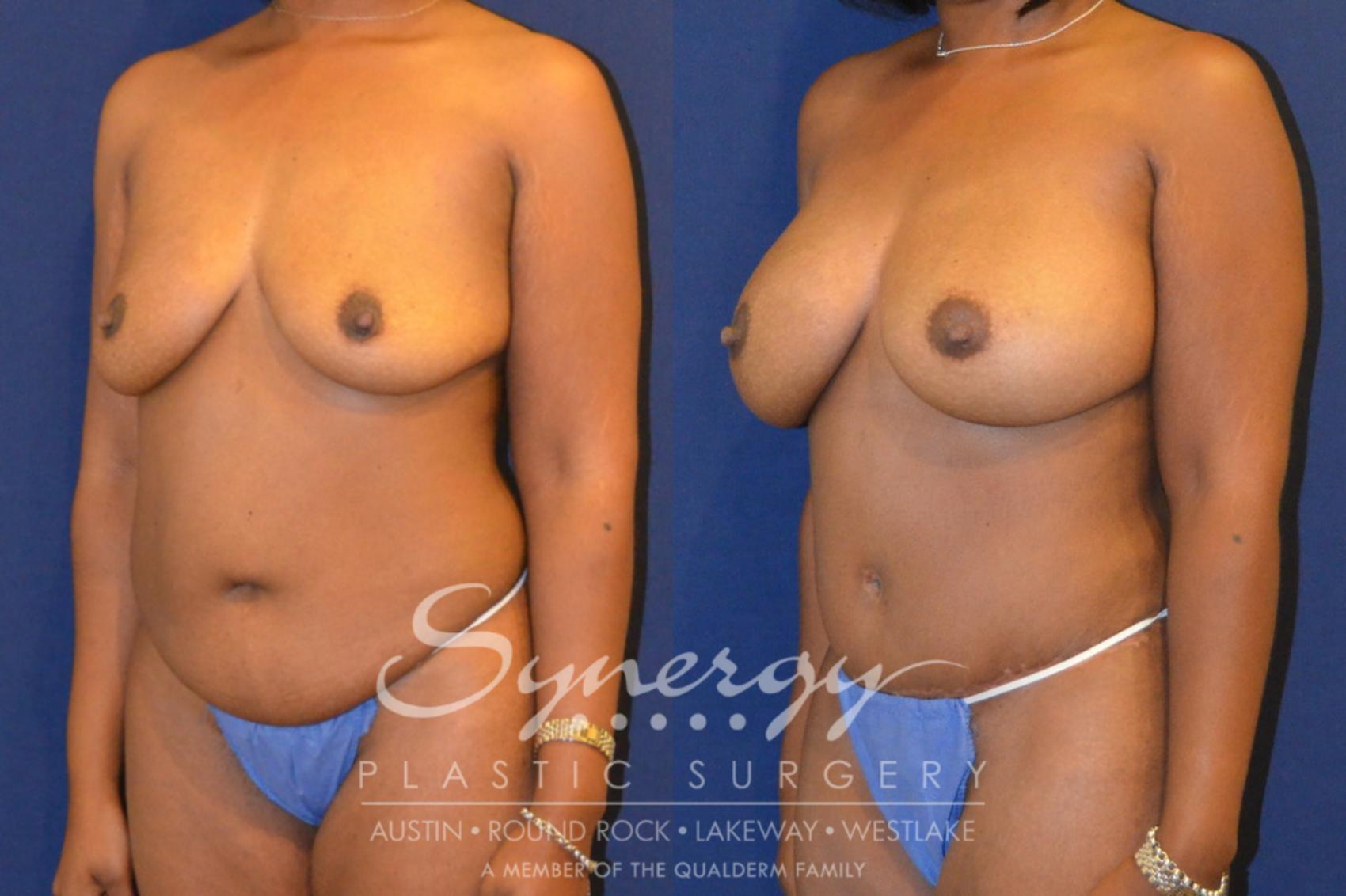 Before & After Mommy Makeover Case 297 View #5 View in Austin, TX