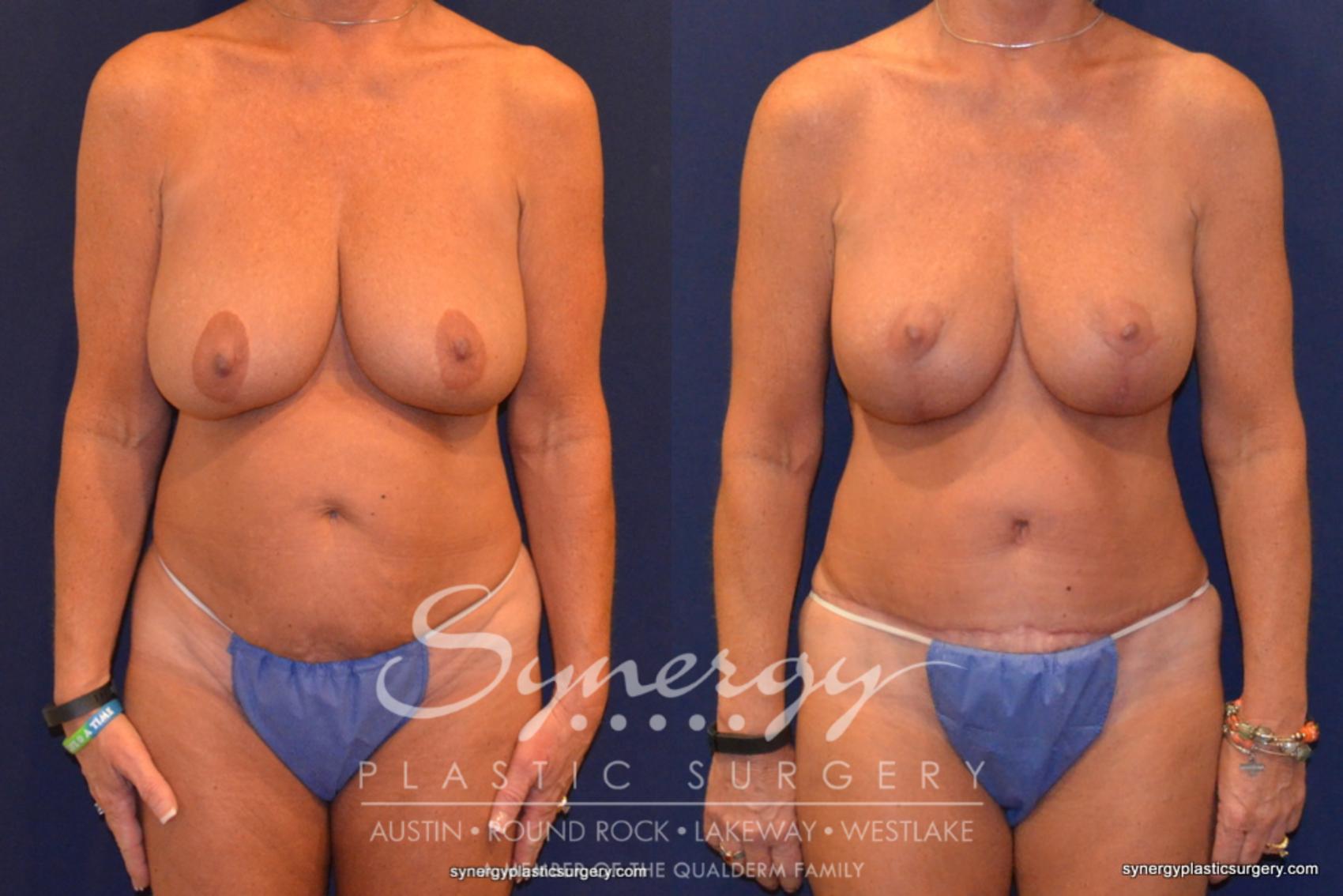 Before & After Mommy Makeover Case 320 View #1 View in Austin, TX