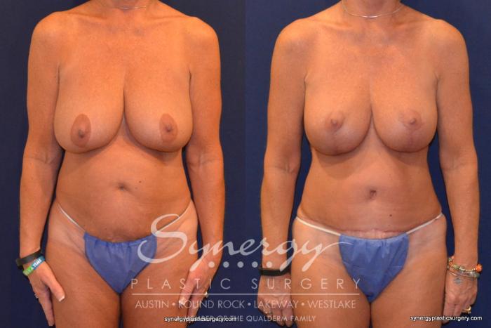 Before & After Mommy Makeover Case 320 View #1 View in Austin, TX