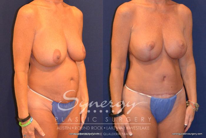 Before & After Mommy Makeover Case 320 View #2 View in Austin, TX