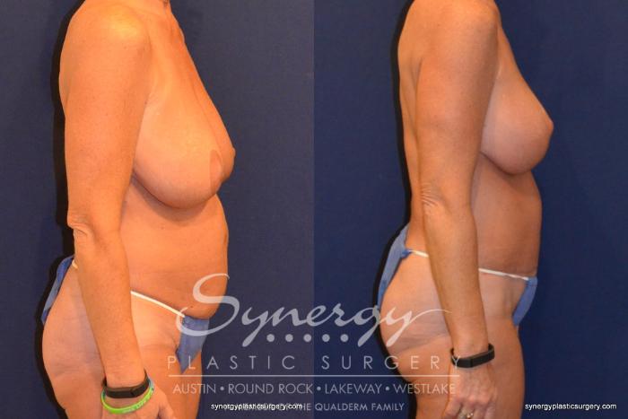 Before & After Mommy Makeover Case 320 View #3 View in Austin, TX