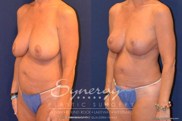 Before & After Mommy Makeover Case 320 View #4 View in Austin, TX