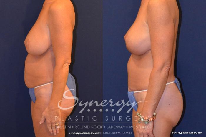 Before & After Mommy Makeover Case 320 View #5 View in Austin, TX