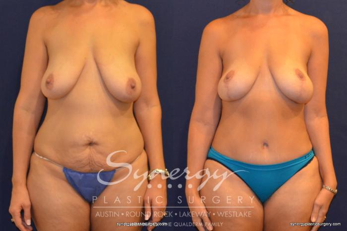 Before & After Mommy Makeover Case 325 View #1 View in Austin, TX