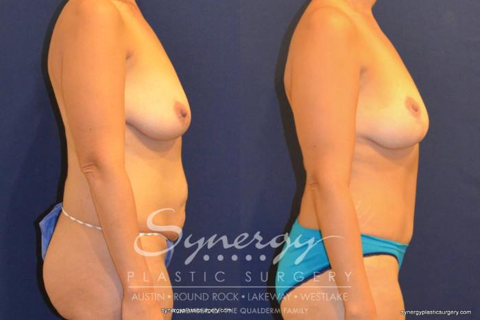 Before & After Mommy Makeover Case 325 View #2 View in Austin, TX