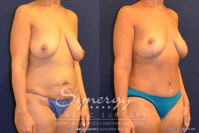 Before & After Mommy Makeover Case 325 View #3 View in Austin, TX