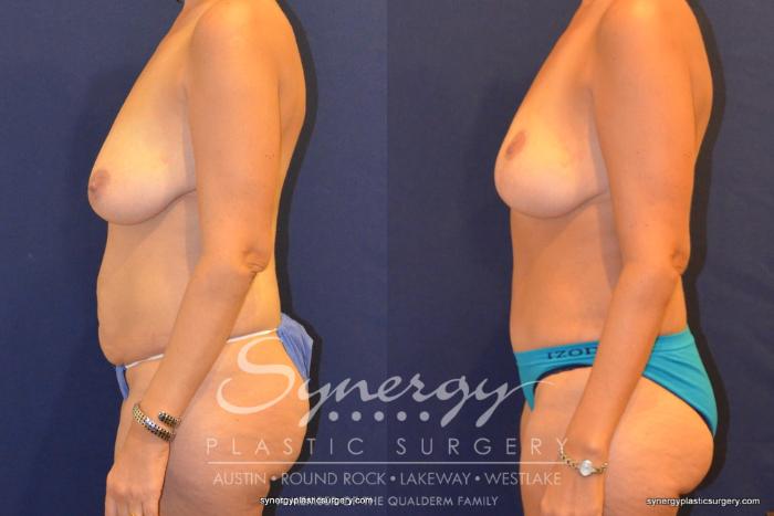 Before & After Mommy Makeover Case 325 View #4 View in Austin, TX