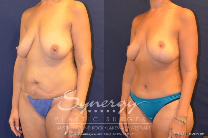 Before & After Mommy Makeover Case 325 View #5 View in Austin, TX