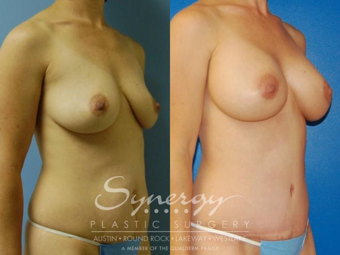 Before & After  Case 34 View #5 View in Austin, TX