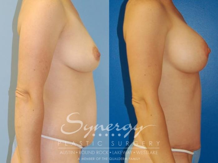 Before & After  Case 34 View #6 View in Austin, TX