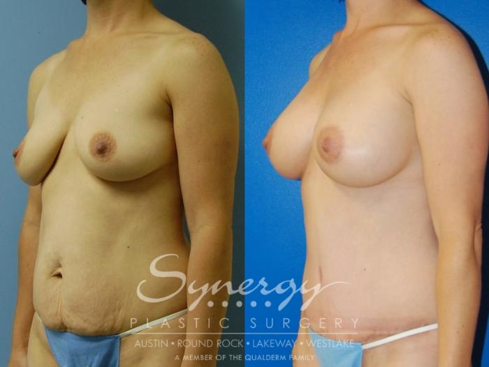 Before & After  Case 34 View #7 View in Austin, TX