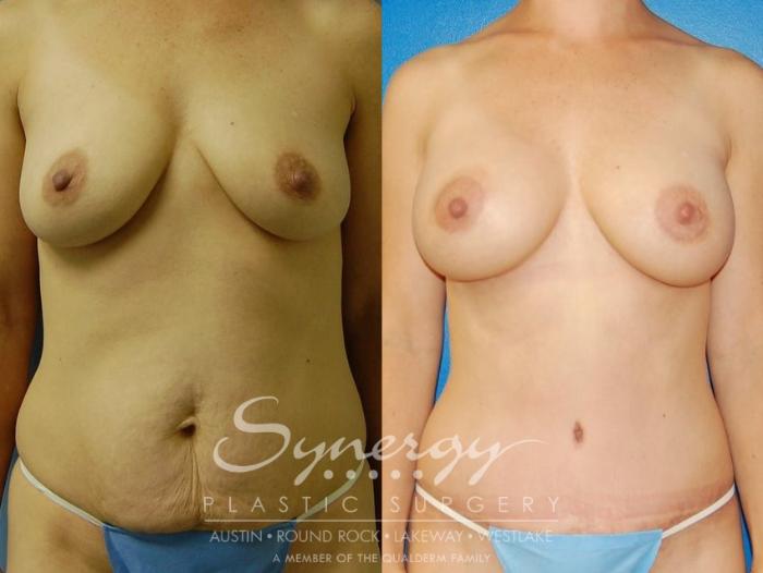 Before & After  Case 34 View #8 View in Austin, TX